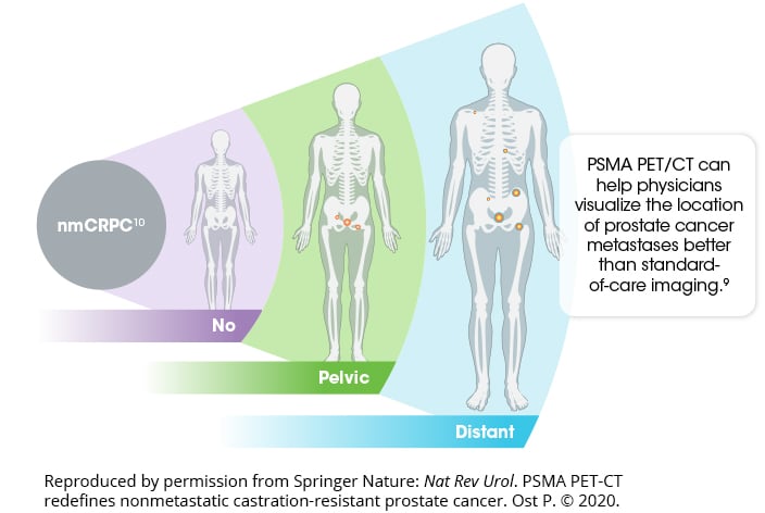 PSMA PET/CT can help physicians visualize the location of prostate cancer recurrences better than standard of care imaging